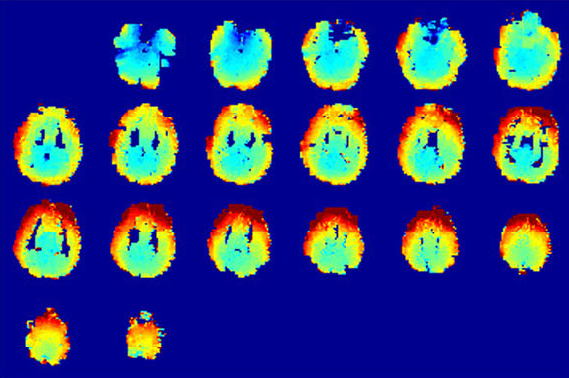 A novel dementia diagnosis strategy on arterial spin labeling magnetic resonance images via pixel-wise partial volume correction and ranking